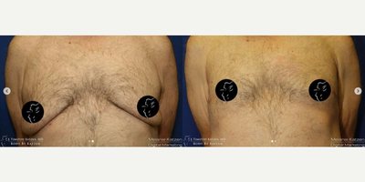 Case 8827 - 35-44 year old woman treated with Gynecomastia Surgery
