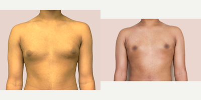 Case 8828 - 18-24 year old man treated with Gynecomastia Surgery