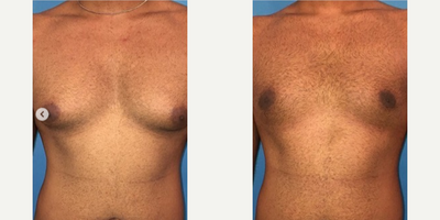 Case 8829 - Man treated with Gynecomastia Surgery