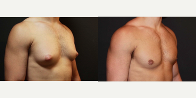 Case 8830 - 35-44 year old man treated with Gynecomastia Surgery