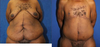Case 8831 - Gynecomastia Surgery