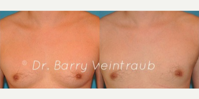 Case 8832 - Man treated with Gynecomastia Surgery