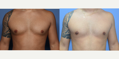 Case 8833 - 25-34 year old man treated with Gynecomastia Surgery