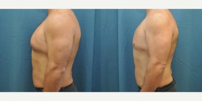 Case 8848 - Man treated with Gynecomastia Surgery