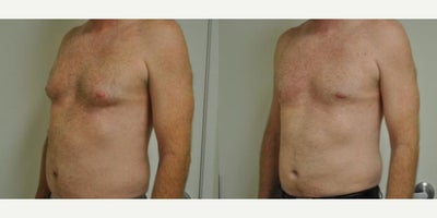 Case 8849 - Man treated with Gynecomastia Surgery