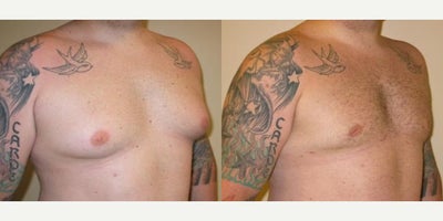 Case 8850 - Man treated with Gynecomastia Surgery