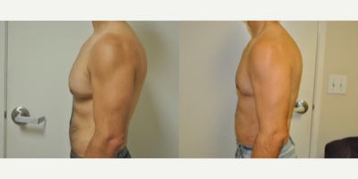 Case 8851 - Man treated with Gynecomastia Surgery
