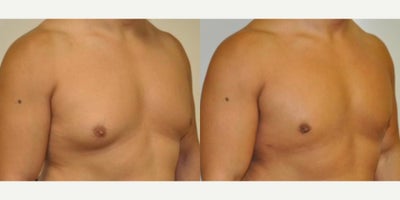 Case 8852 - Man treated with Gynecomastia Surgery