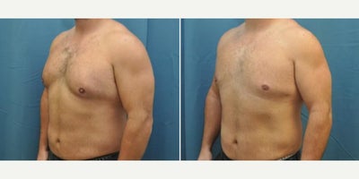 Case 8853 - Man treated with Gynecomastia Surgery
