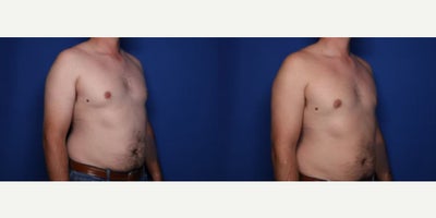 Case 8855 - 31 year old man treated with Gynecomastia Surgery
