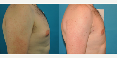 Case 8857 - Man treated with Gynecomastia Surgery