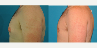 Case 8858 - Man treated with Gynecomastia Surgery