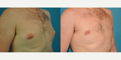Case 8859 - Man treated with Gynecomastia Surgery