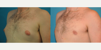 Case 8860 - Man treated with Gynecomastia Surgery
