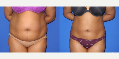 Case: 8869 - before and after photo of Woman treated with Liposuction by Shahram Salemy, MD, FACS