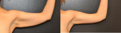 Case: 8870 - before and after photo of 34 year old woman treated with Arm Lift, Liposuction by Robert L. Steely, MD, FACS