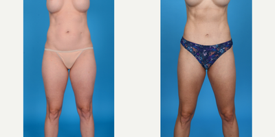 Case: 8871 - before and after photo of 35-44 year old woman treated with Abdominal Etching, Belly Button Surgery, Diastasis Recti Repair, Drainless Tummy Tuck, Liposcu by John L. Burns Jr., MD