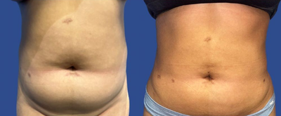 Case: 8872 - before and after photo of Woman treated with Liposuction by Stephen T. Greenberg, MD, FACS