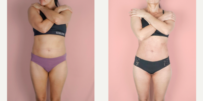 Case: 8874 - before and after photo of 35-44 year old woman treated with Liposuction by Finny George, MD