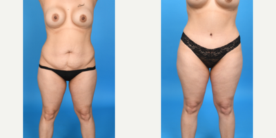 Case: 8875 - before and after photo of 35-44 year old woman treated with Abdominal Etching, Diastasis Recti Repair, Drainless Tummy Tuck, Liposculpture, Liposuction, M by John L. Burns Jr., MD