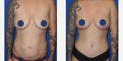 Case: 8877 - before and after photo of Woman treated with Breast Lift, Breast Fat Transfer, Tummy Tuck, Liposuction, Mommy Makeover by Shahram Salemy, MD, FACS