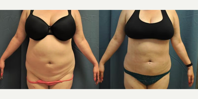 Case 8878 - Woman treated with Liposuction