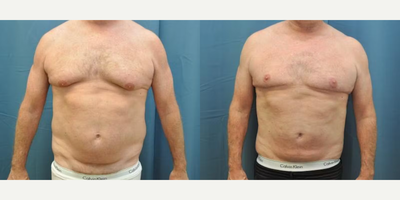Case 8879 - Man treated with Liposuction