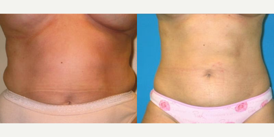 Case 8880 - Woman treated with Liposuction