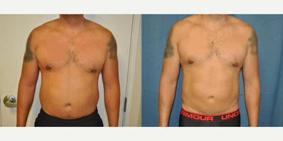 Case 8881 - Man treated with Liposuction