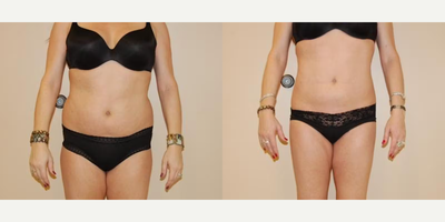 Case 8882 - Woman treated with Liposuction