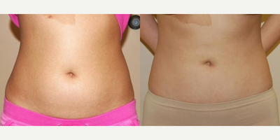 Case 8883 - Woman treated with Liposuction