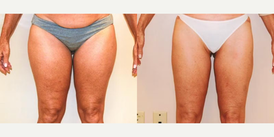 Case 8884 - Woman treated with Liposuction