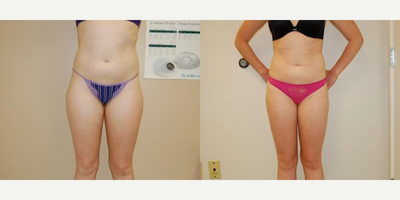 Case 8885 - Woman treated with Liposuction