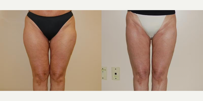 Case 8886 - Woman treated with Liposuction