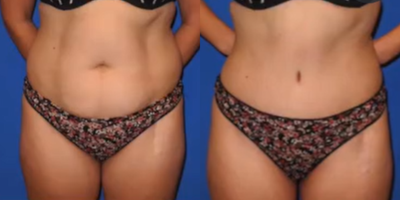 Case 8887 - Woman treated with Liposuction