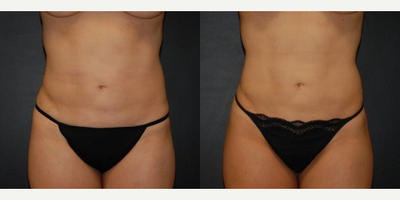 Case 8897 - Woman treated with Liposuction