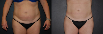 Case 8898 - Woman treated with Liposuction
