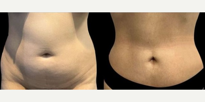 Case 8899 - Woman treated with Liposuction