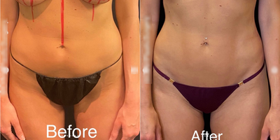 Case 8901 - Woman treated with Liposuction