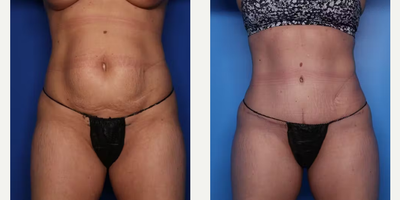 Case 8902 - 39 year old woman treated with Tummy Tuck, Liposuction