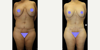Case 8904 - 35-44 year old woman treated with Liposuction, Lipo 360