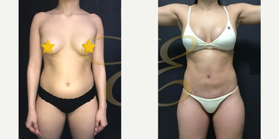 Case 8905 - Woman treated with Liposuction