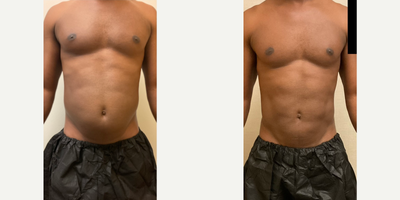 Case 8907 - Man treated with Liposuction