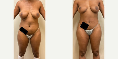 Case 8908 - Woman treated with Liposuction