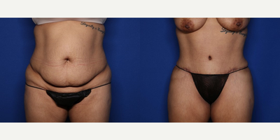 Case 8909 - 25 year old woman treated with Liposuction