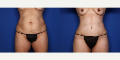 Case 8910 - 50 year old woman treated with Liposuction, BodyTite