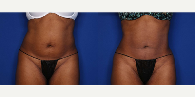 Case 8911 - 41 year old woman treated with Liposuction, BodyTite