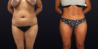 Case 8912 - 35-44 year old woman treated with Liposuction