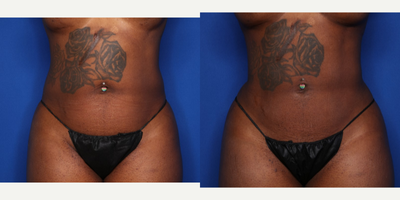 Case 8913 - 35-44 year old woman treated with BodyTite, Liposuction
