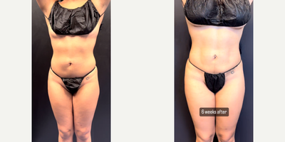 Case 8915 - Woman treated with Liposuction